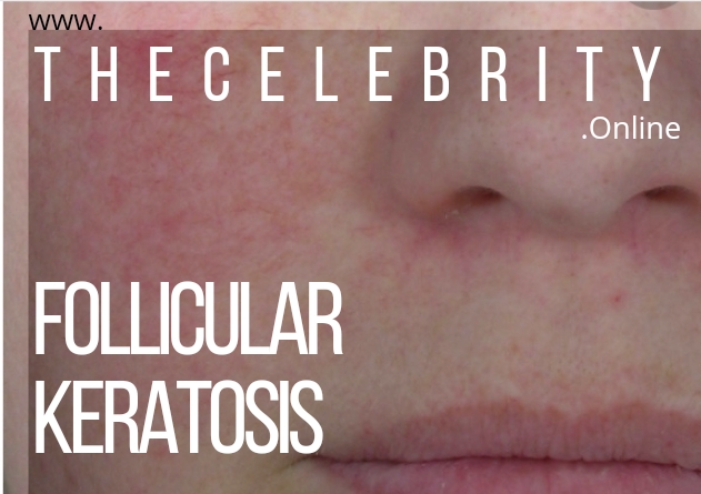 Follicular Keratosis: The Annoying Tiny Pimples Can Be Treated By These 3 Ways